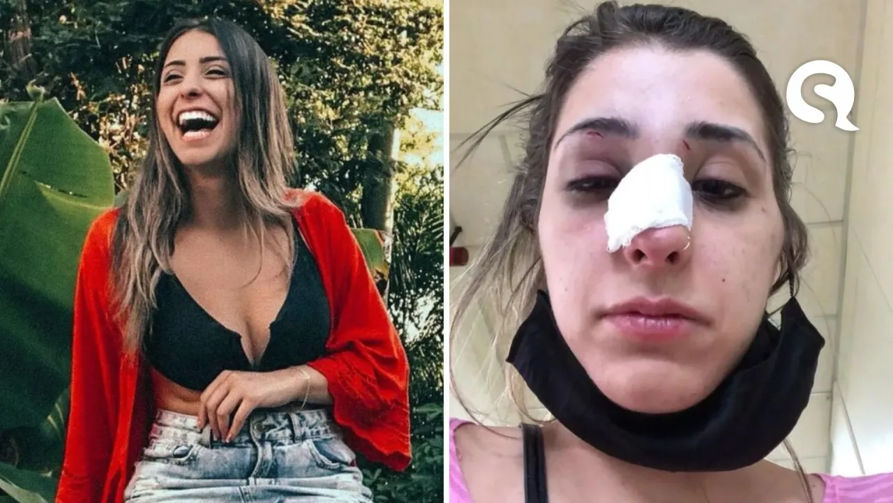 Modelo é agredida por ex-namorado um dia após terminar relacionamento e fica com nariz ‘deformado’