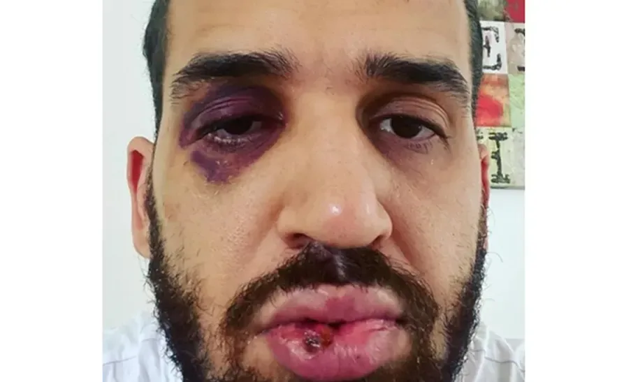 Infectologista é agredido após alertar sobre riscos da pandemia