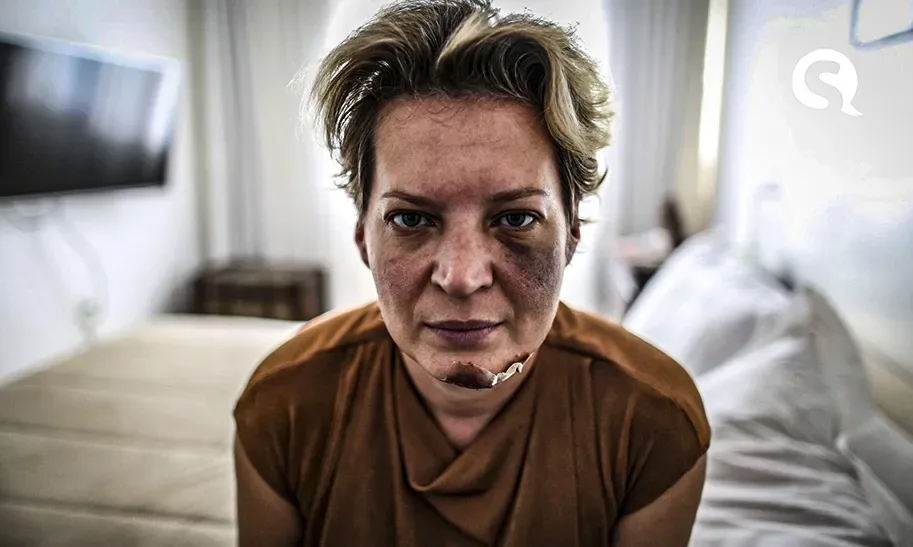 Polícia do DF descarta agressão e diz que Joice Hasselman sofreu ‘queda de própria altura’