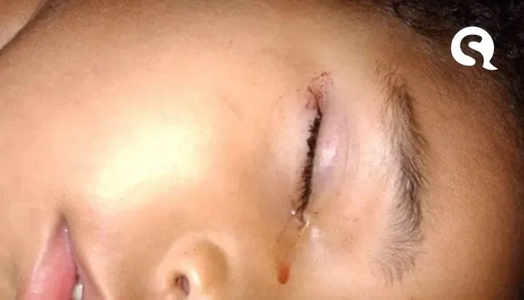 Menina de 3 anos tem olho mordido por rato enquanto dormia