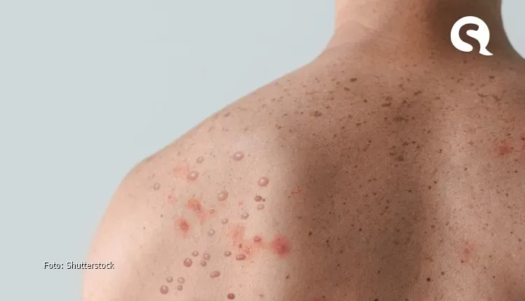 Monkeypox é mais comum em homens de 18 a 49 anos no Brasil, diz Ministério da Saúde