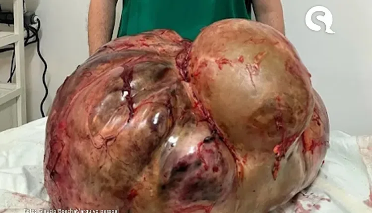 Tumor com cerca de 46 kg é retirado de mulher em cirurgia de emergência
