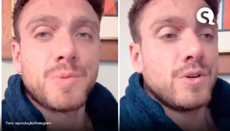 Após briga na Record, Vini Buttel mostra rosto ferido e culpa Hadson pela confusão