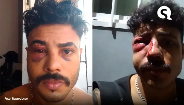 Jovem negro diz ter sido agredido por homens brancos durante jogo do Brasil e pode perder visão
