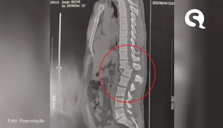 Aluno que ficou paraplégico após ser atingido por aparelho em academia volta a sentir as pernas, no Ceará