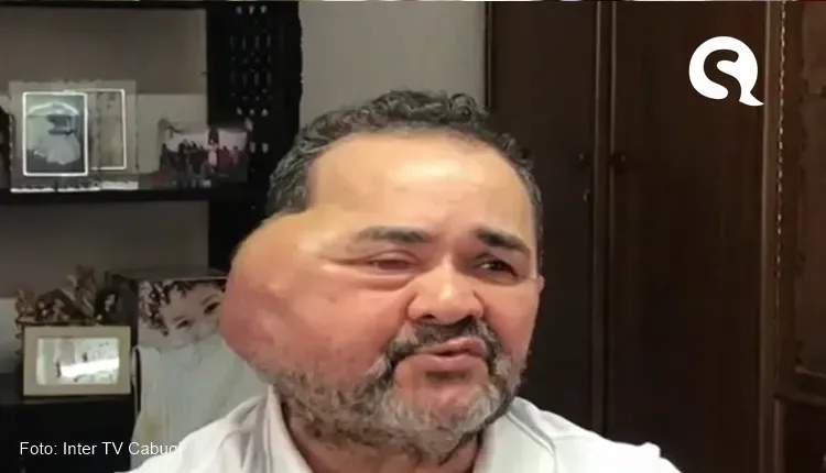 Idoso de 65 anos aguarda há 5 meses para tirar tumor gigante no crânio