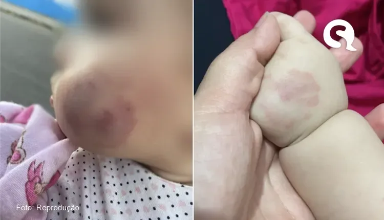 Criança de 8 meses aparece com hematomas e mãe denuncia suposta agressão de monitores de creche no Ceará