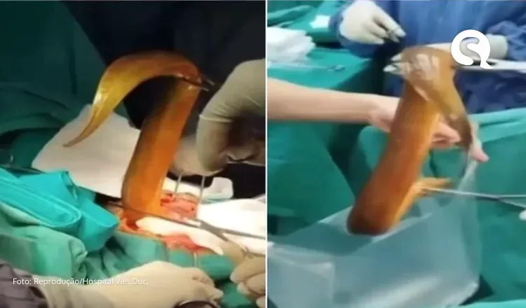 Médicos retiram enguia viva de 60 cm do corpo de paciente em cirurgia no Vietnã após ele inserir pelo ânus para prazer sexual
