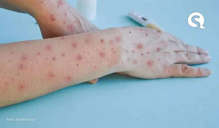 “Mpox não é a nova Covid”, diz diretor da Organização Mundial da Saúde