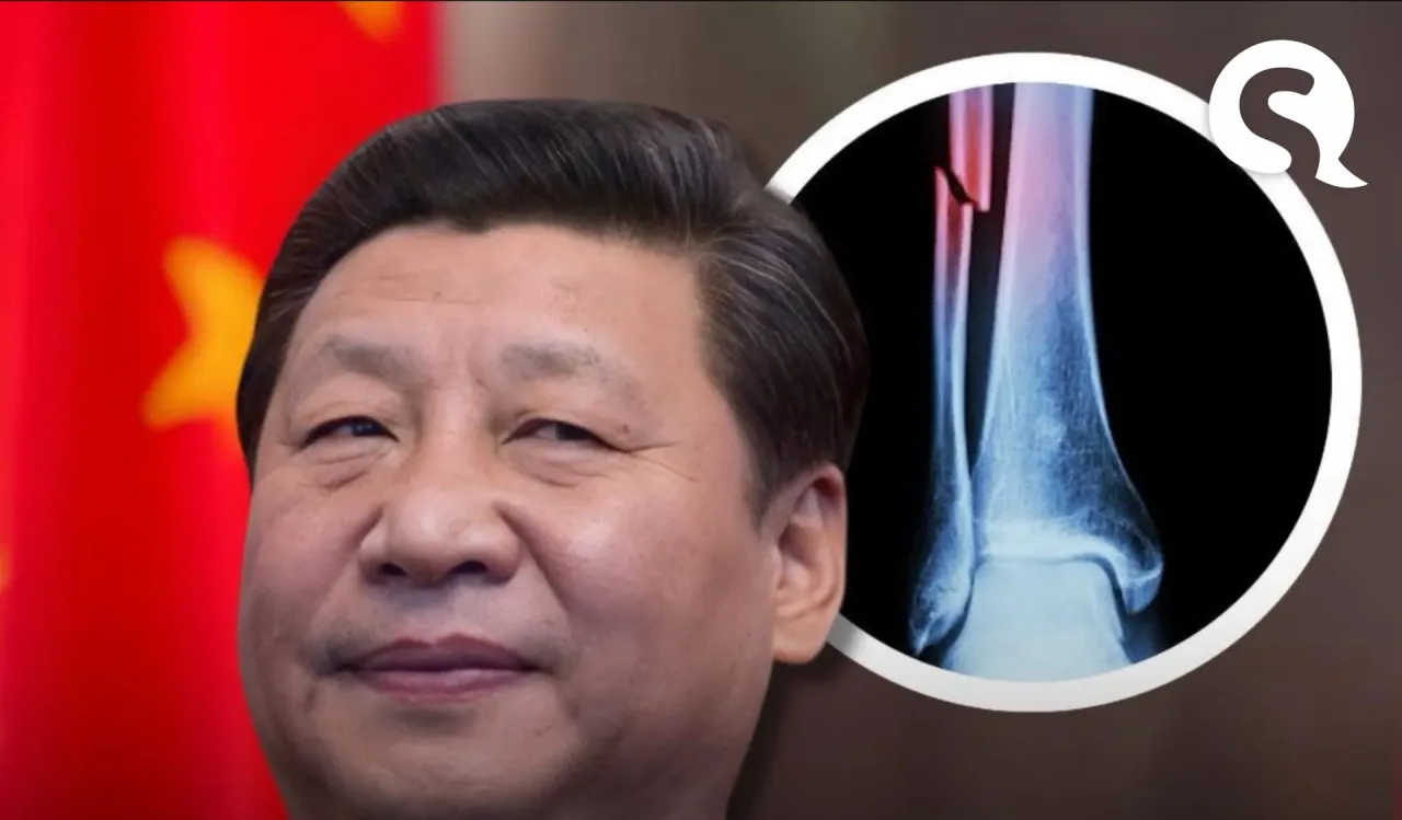 China cria cola óssea que repara fraturas em 3 minutos sem cirurgia, metal ou longos períodos de recuperação