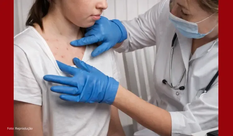 Ceará confirma primeiro caso de Mpox em 2026