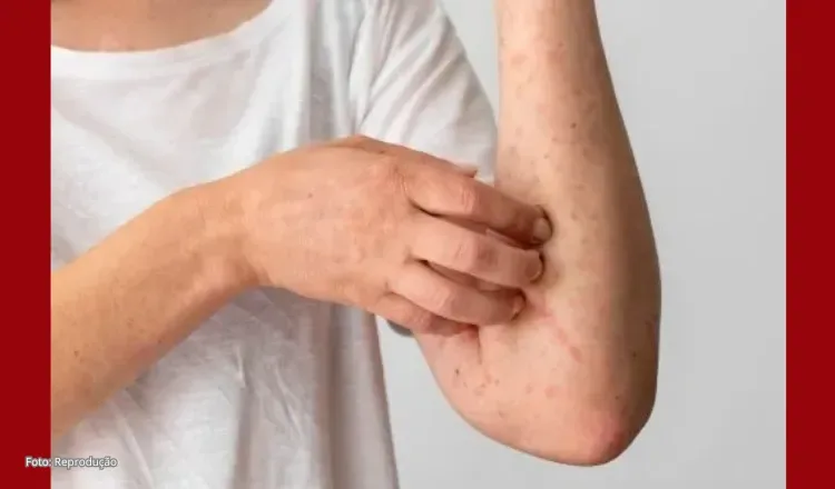 Ceará confirma terceiro caso de mpox em 2026 e soma 29 notificações da doença