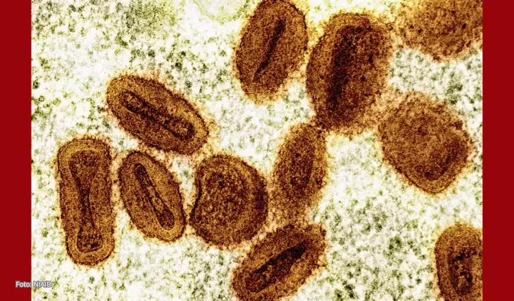 Ceará registra 2º caso de mpox em 2026